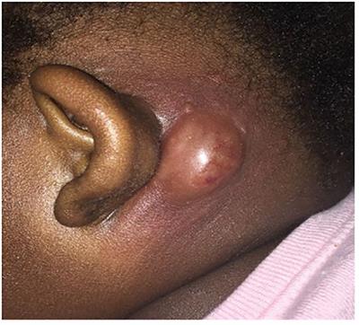 Sweet syndrome associated with moderate leukocyte adhesion deficiency type I: a case report and review of the literature
